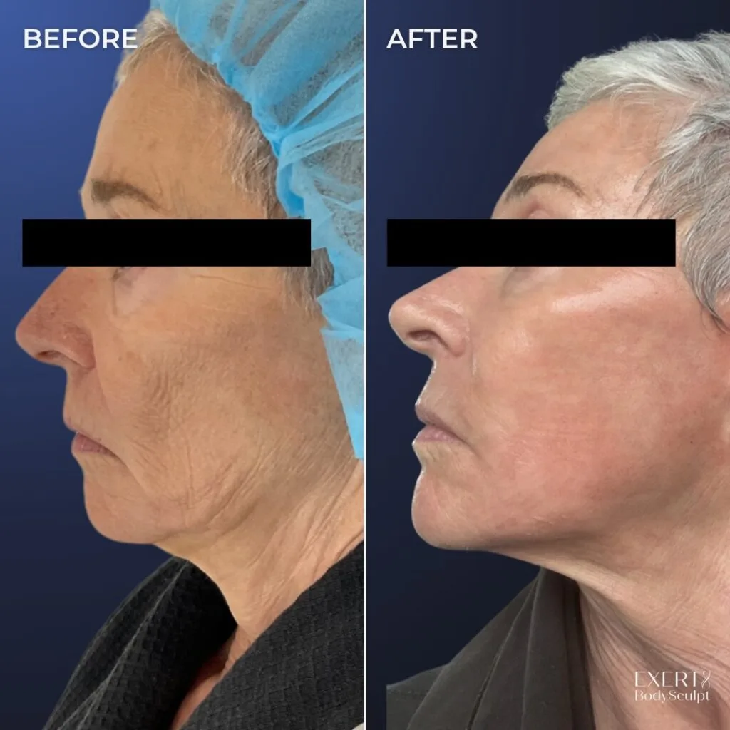 Before and after side profile photos showing improved jawline definition and skin firmness