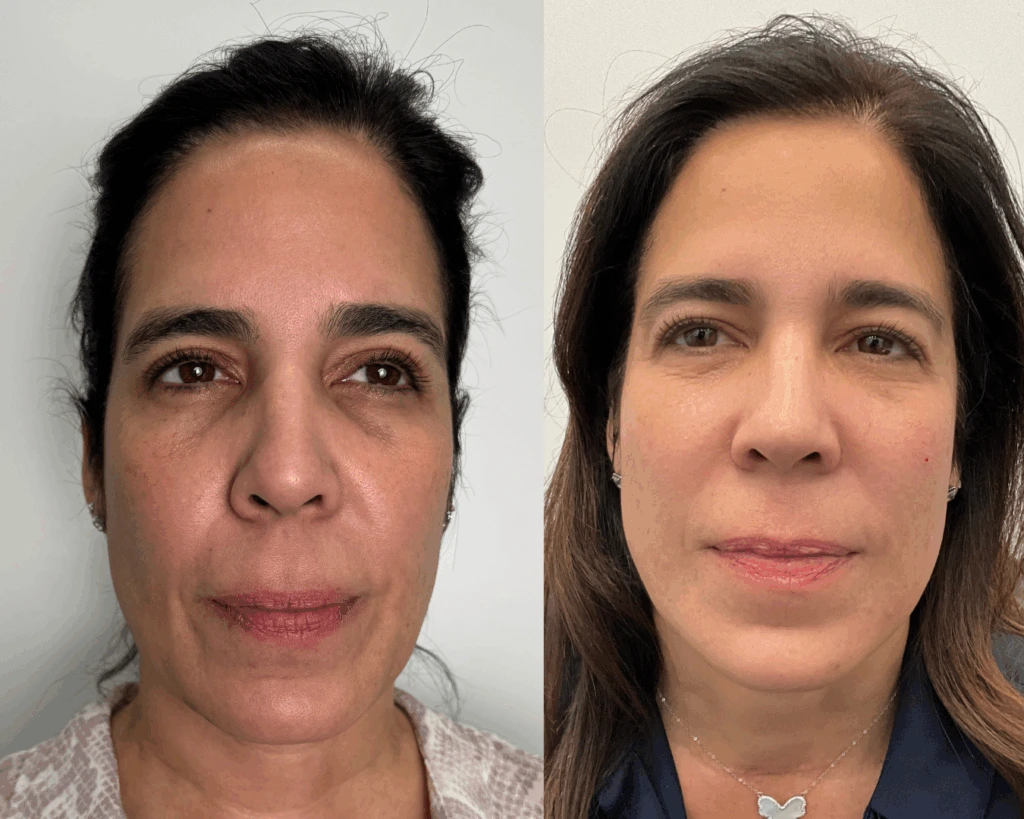 Before and after comparison of woman's face showing improved skin tone and reduced facial puffiness