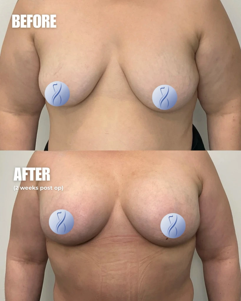 Before and after comparison showing chest, labeled before and after 2 weeks post op