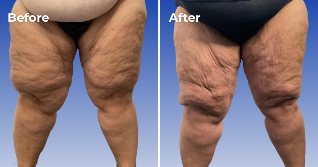 Weight Loss Ft Myers Florida