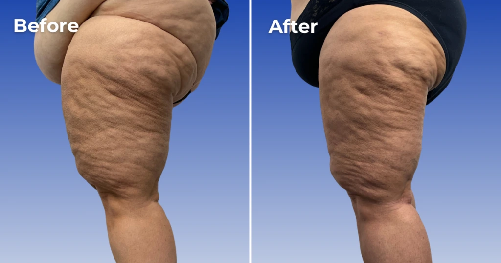 Weight Loss Program Ft Myers Florida