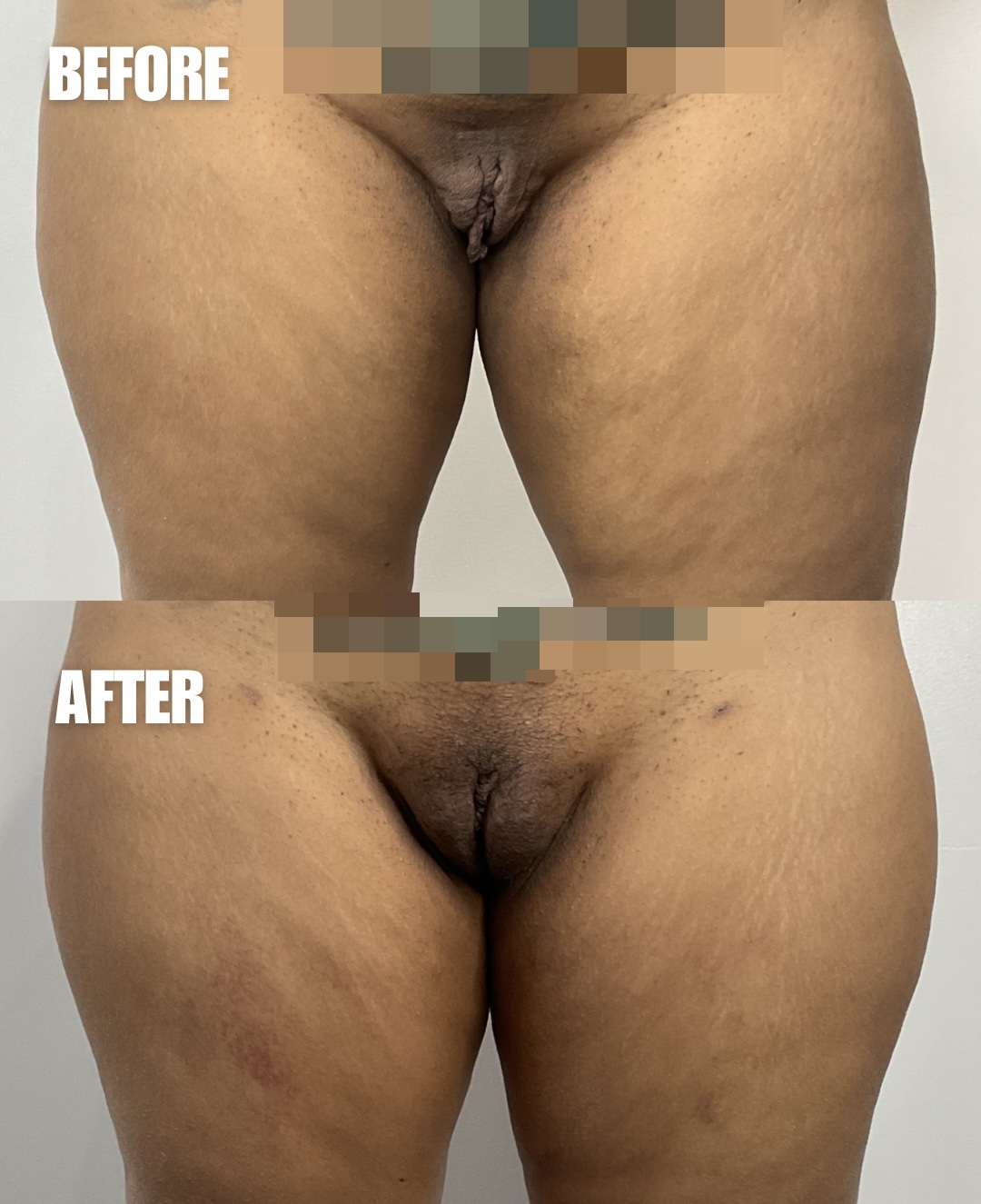 Before and after comparison of labiaplasty results showing reduced tissue appearance