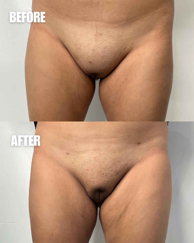 Before and after comparison of male genital contouring results from frontal view