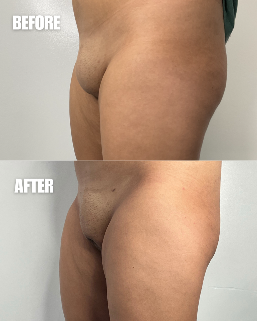 Before and after comparison of buttock augmentation results from side profile