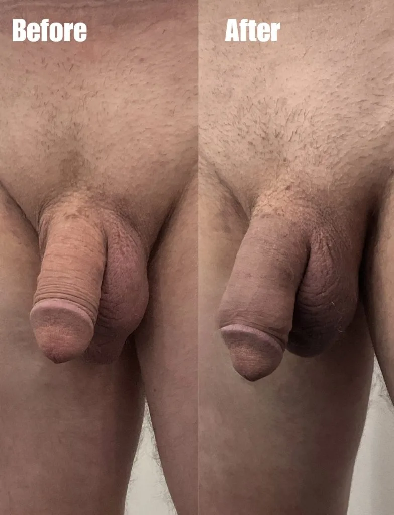 Before and after comparison showing increased hair growth and density
