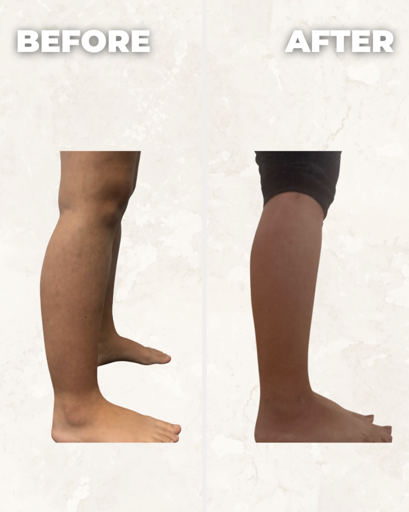Before and after comparison of leg showing improved skin texture and tone