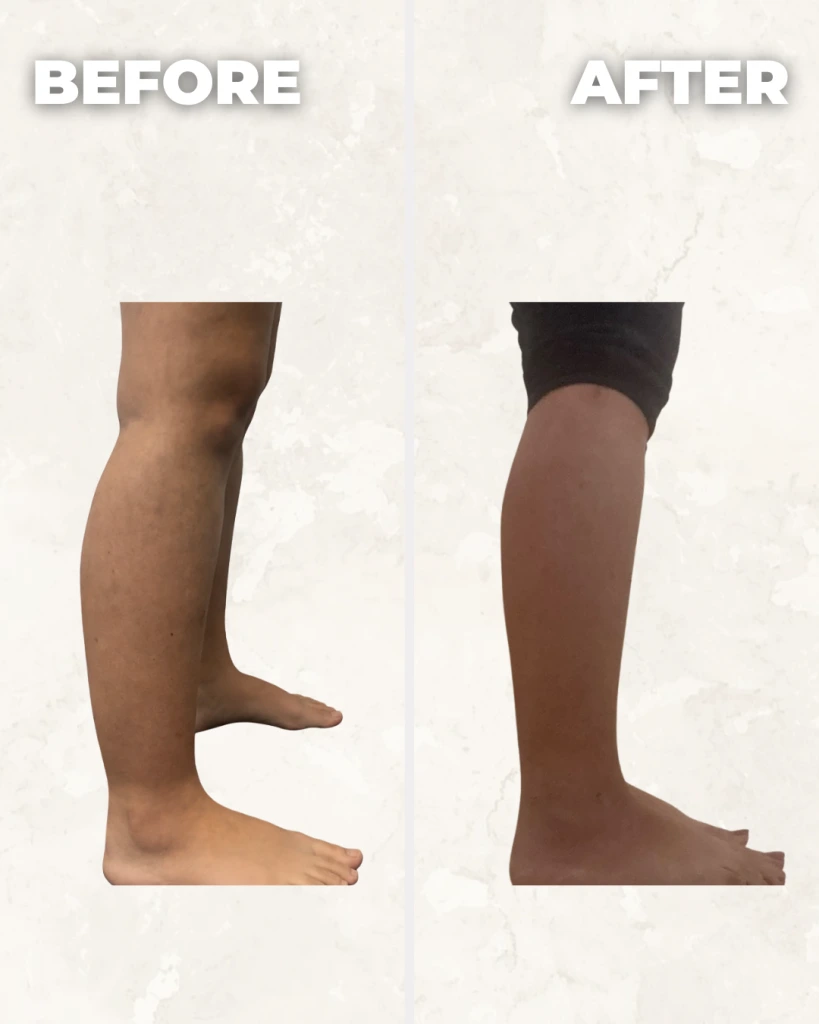 Before and after comparison of leg showing improved skin texture and tone