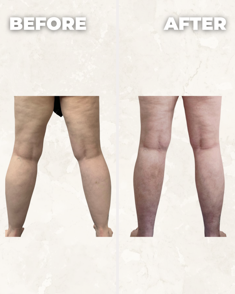 Before and after comparison of both legs showing improved skin texture and reduced cellulite appearance