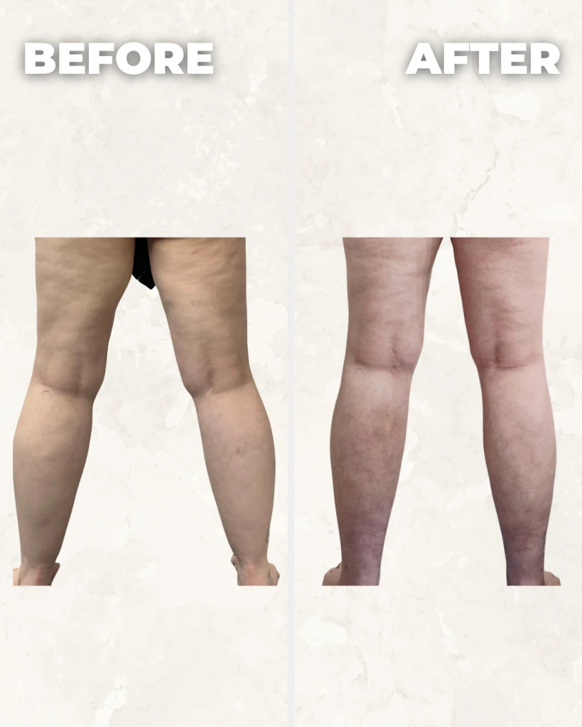 Before and after comparison of both legs showing improved skin texture and reduced cellulite appearance