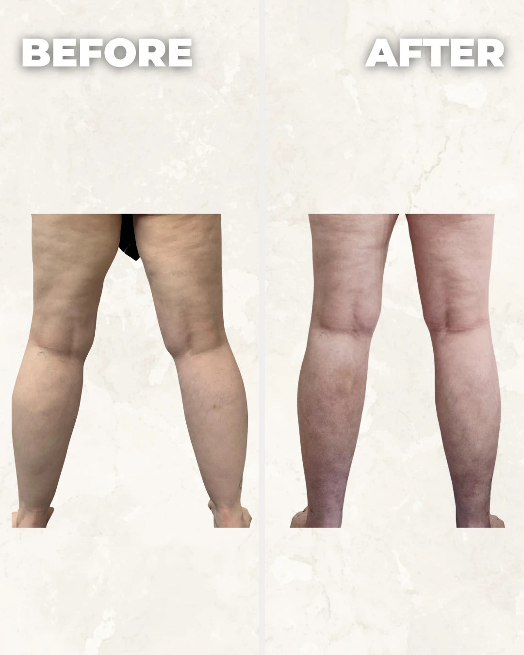 Before and after comparison of both legs showing improved skin texture and reduced cellulite appearance