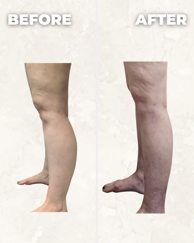 Before and after comparison of leg showing reduced appearance of cellulite