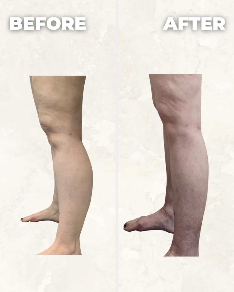 Before and after comparison of leg showing reduced appearance of cellulite
