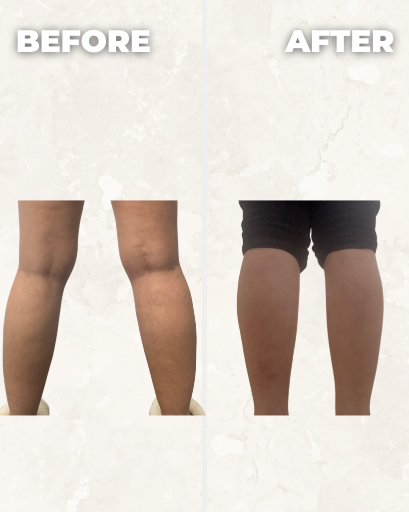 Before and after comparison of legs showing reduced appearance of cellulite