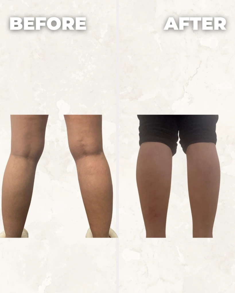 Before and after comparison of legs showing reduced appearance of cellulite