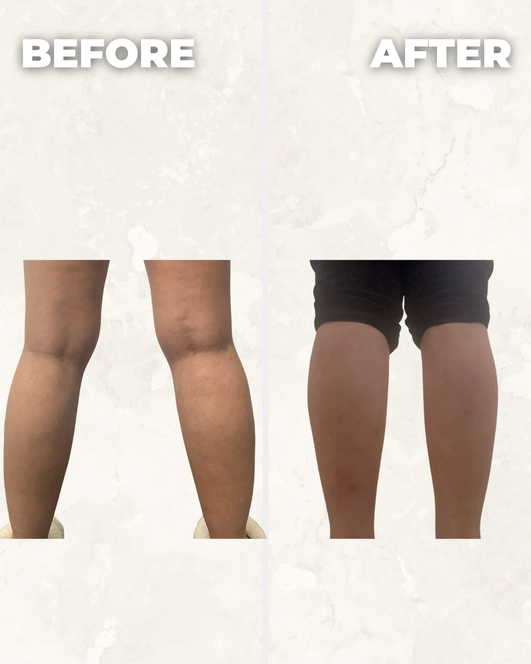 Before and after comparison of legs showing reduced appearance of cellulite