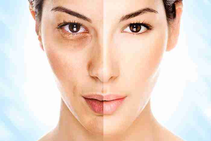 Split-screen facial comparison showing under-eye area before and after treatment