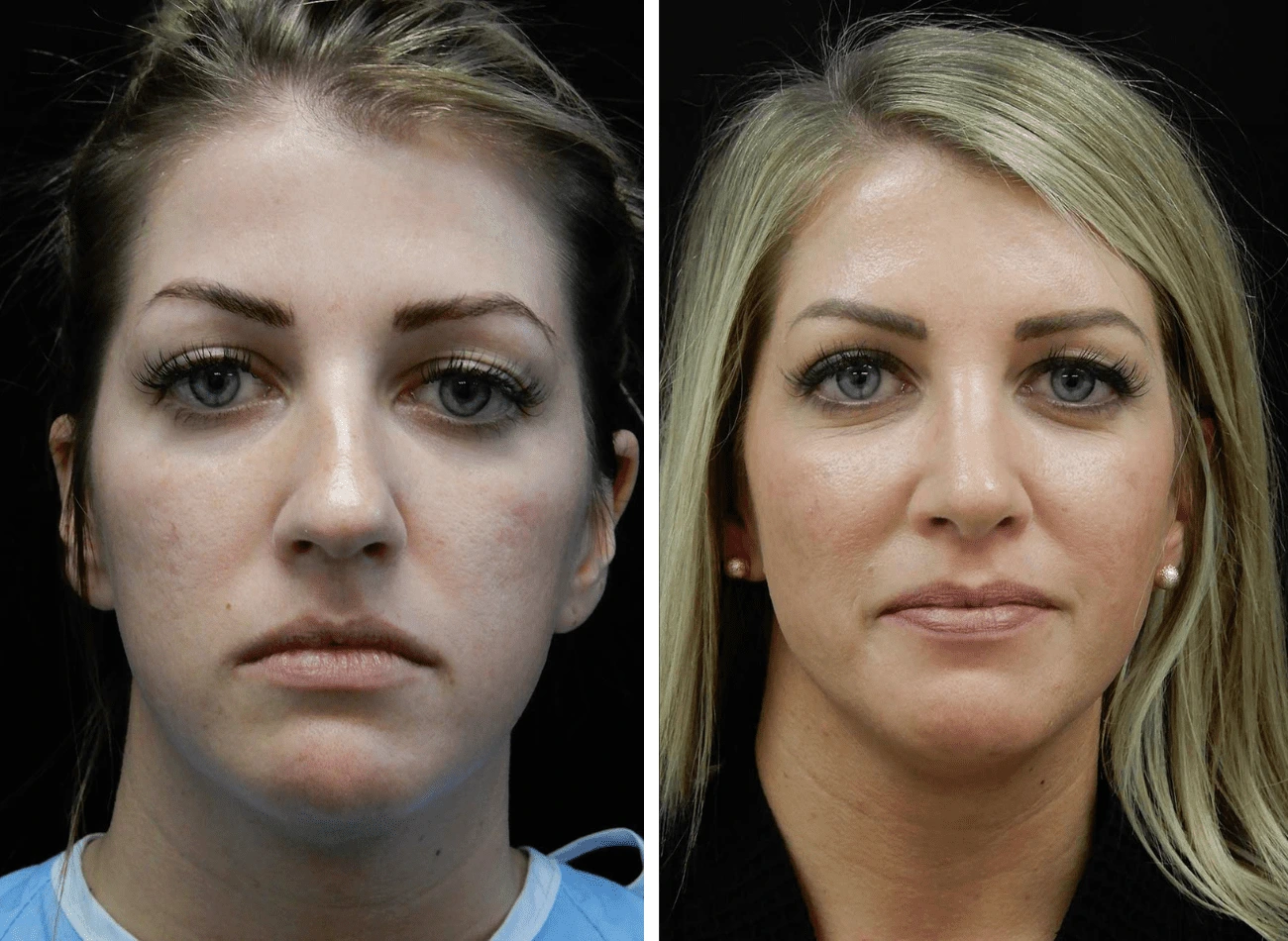 Before and after frontal comparison of a woman's face showing improved facial proportions and skin quality