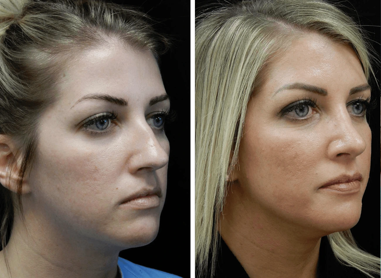 Before and after side profile comparison of a woman's face showing enhanced facial contours