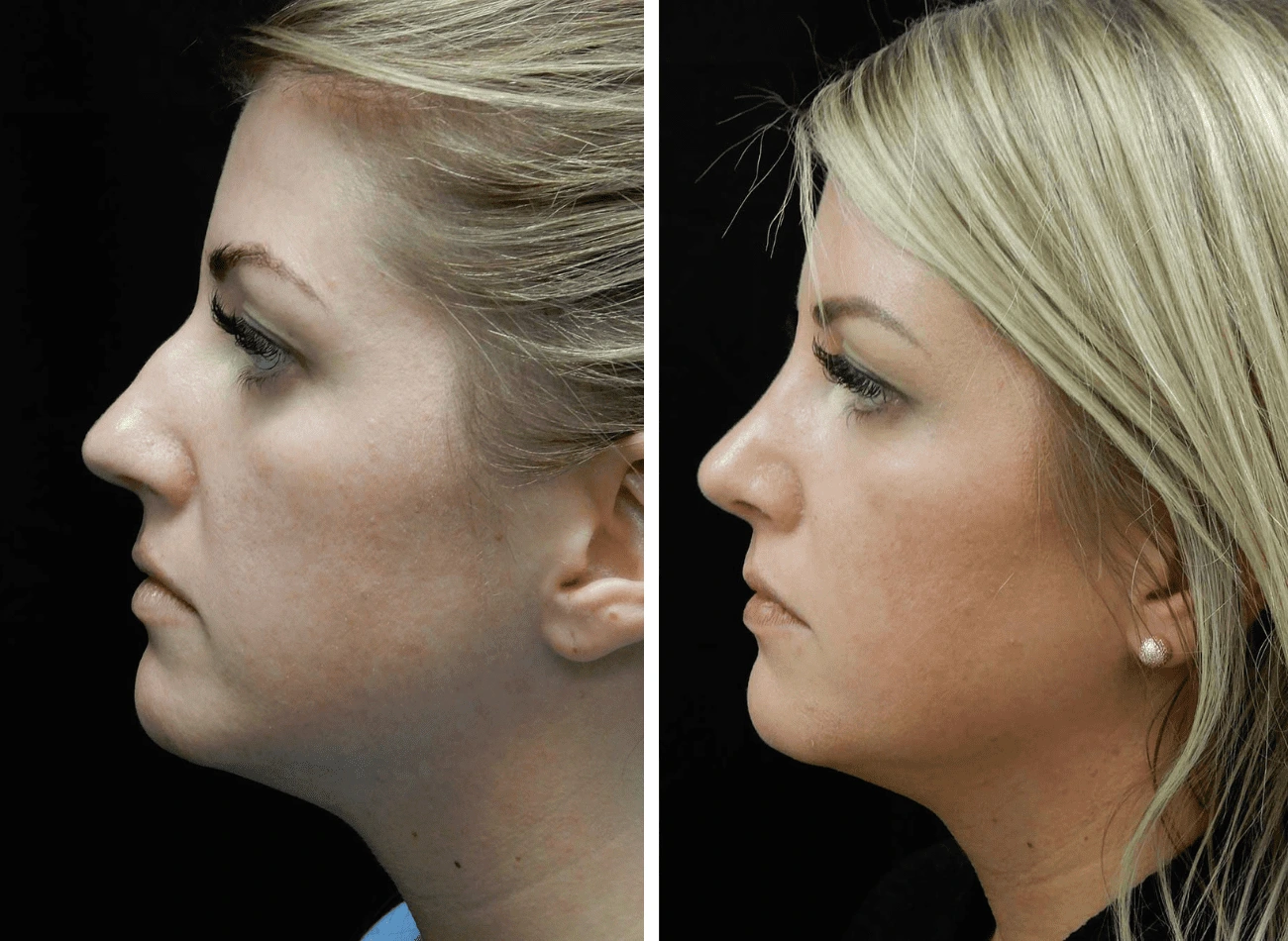 Before and after side profile comparison of a woman's face showing improved chin and jawline definition