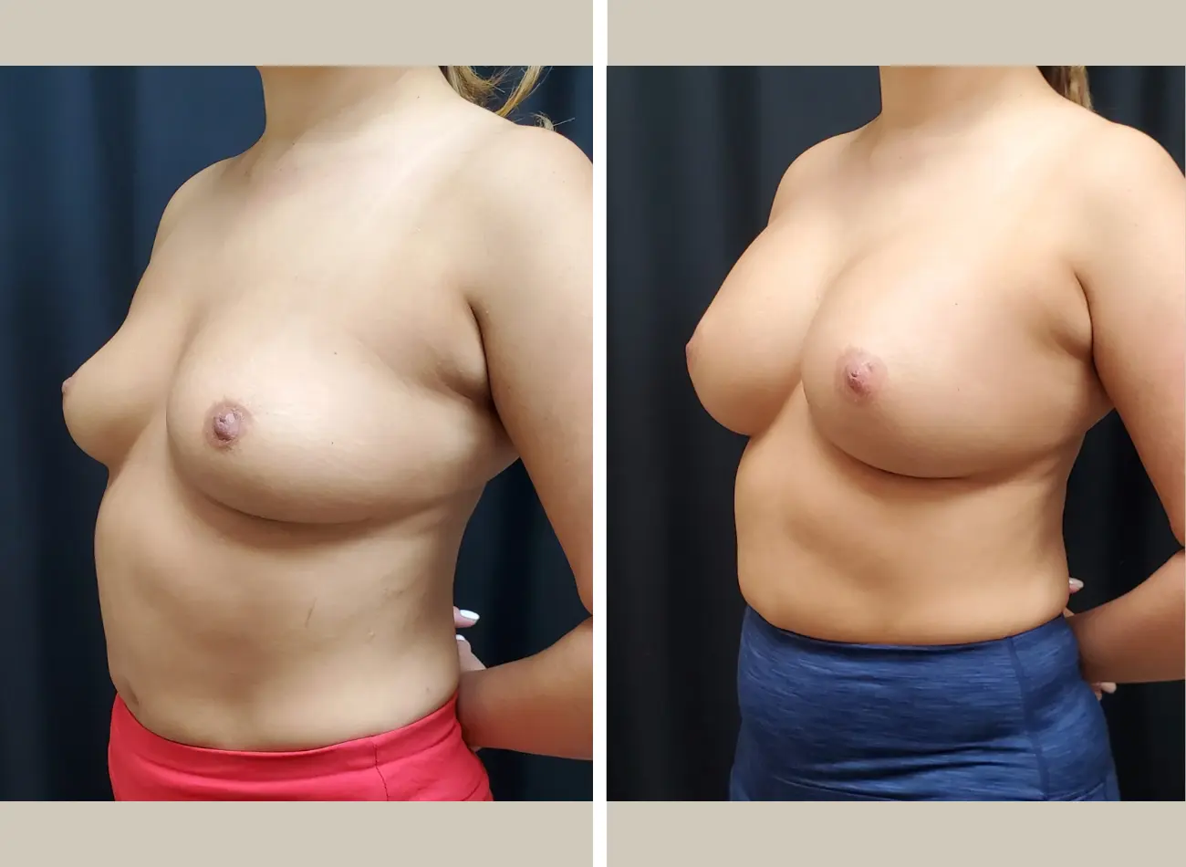 Before and after breast augmentation, oblique view