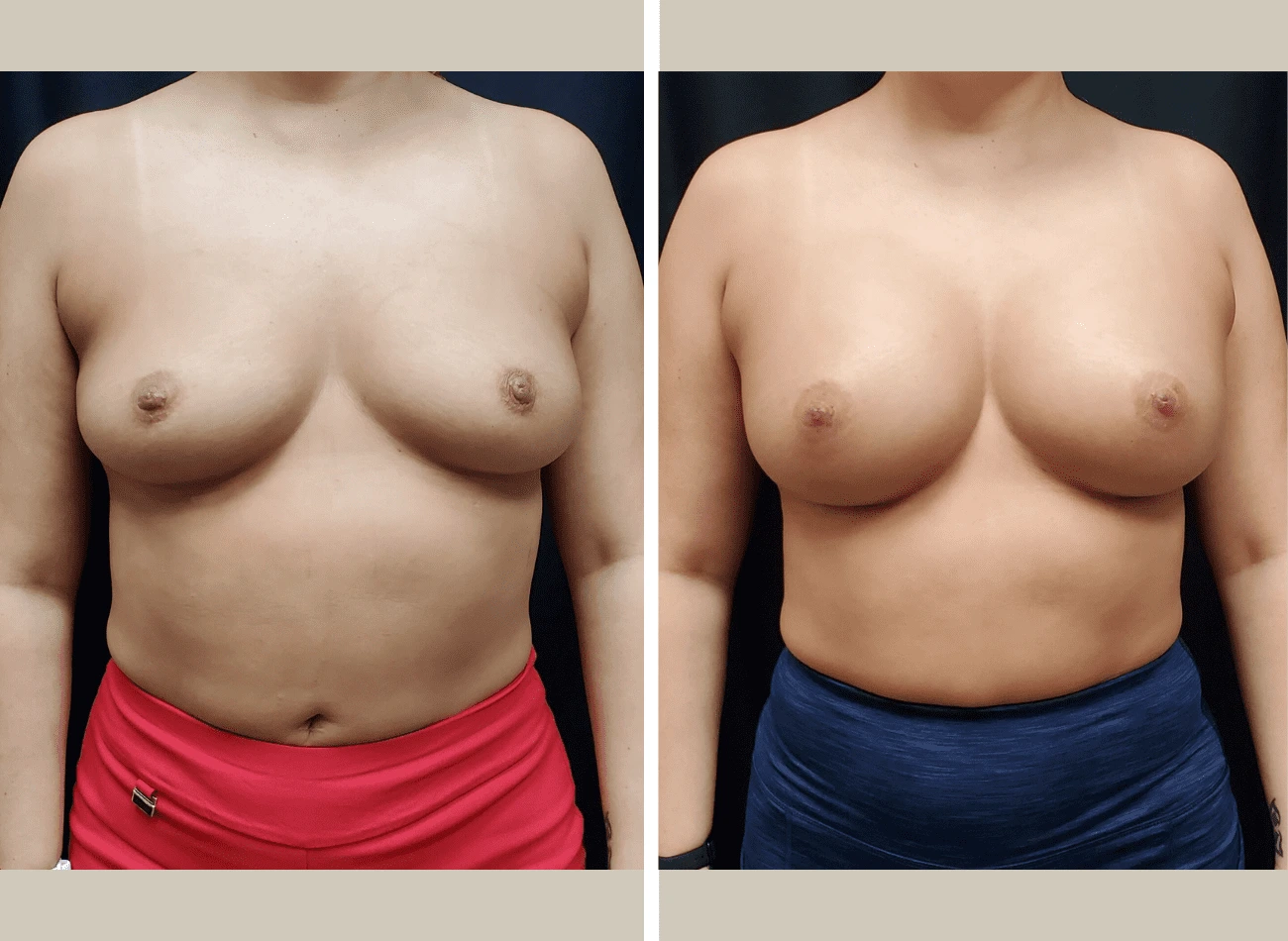 Before and after front view of breast augmentation results