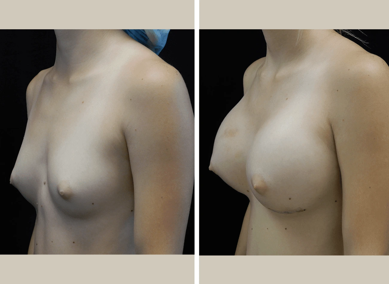 Before and after breast augmentation, oblique view