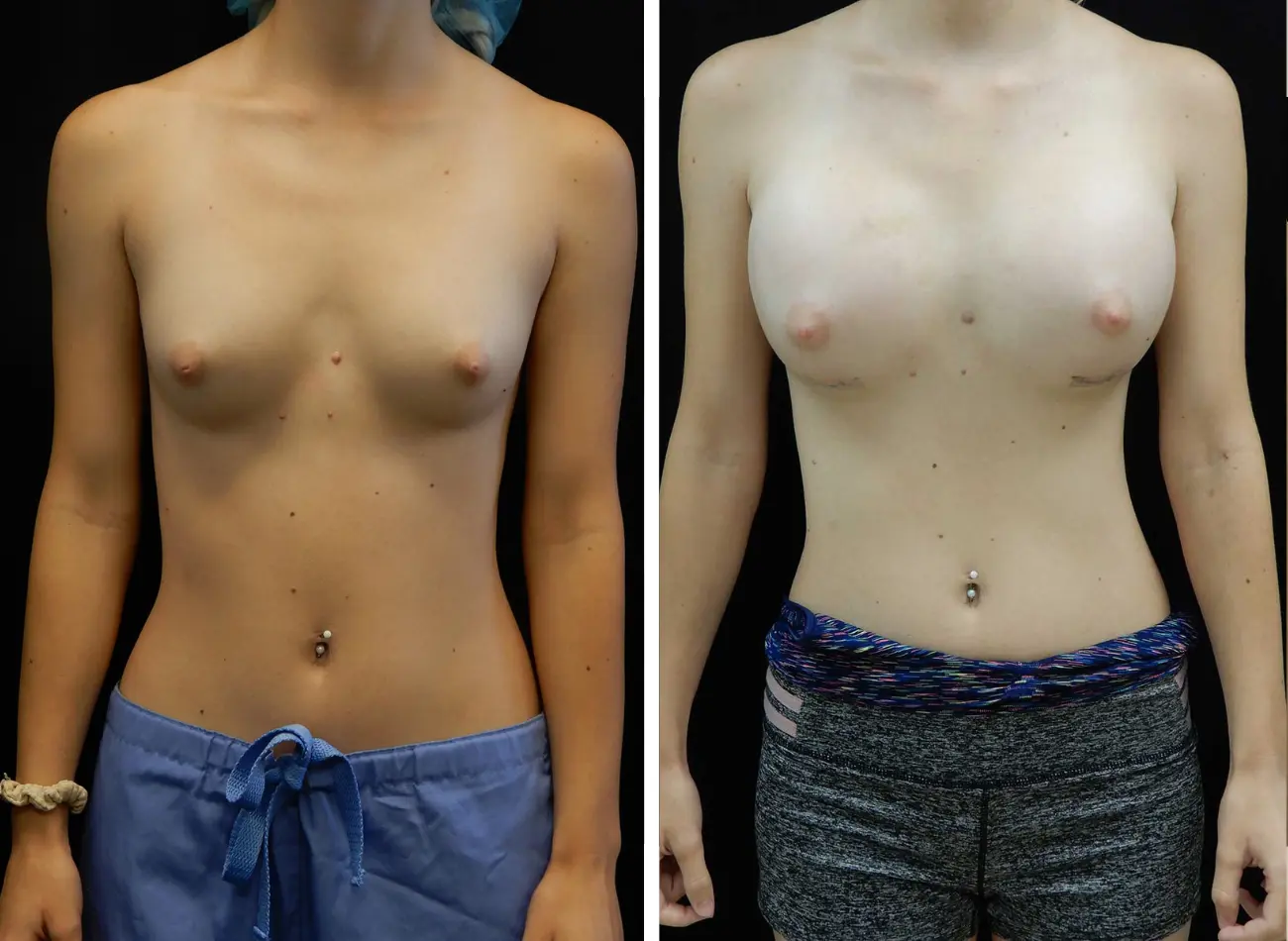 Before and after breast augmentation, frontal view