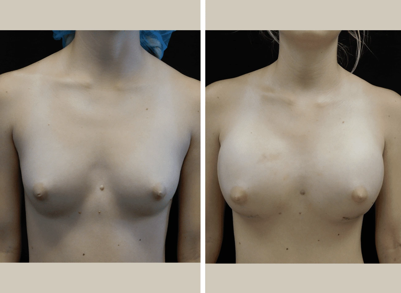 Before and after breast augmentation, frontal view
