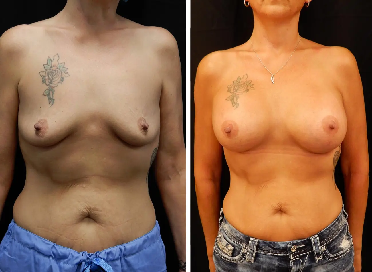 Before and after breast augmentation with different skin tones, frontal view