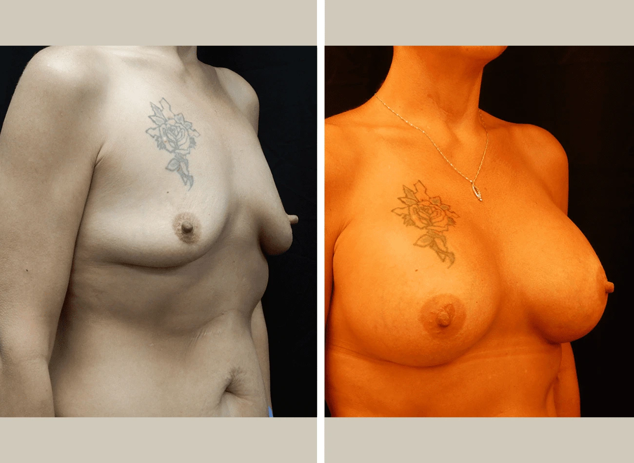 Before and after breast augmentation, oblique view