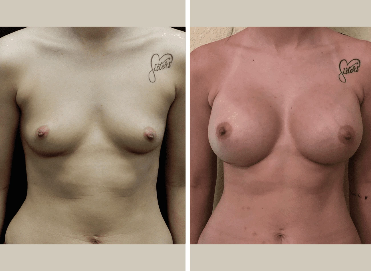 Breast augmentation before and after, front view