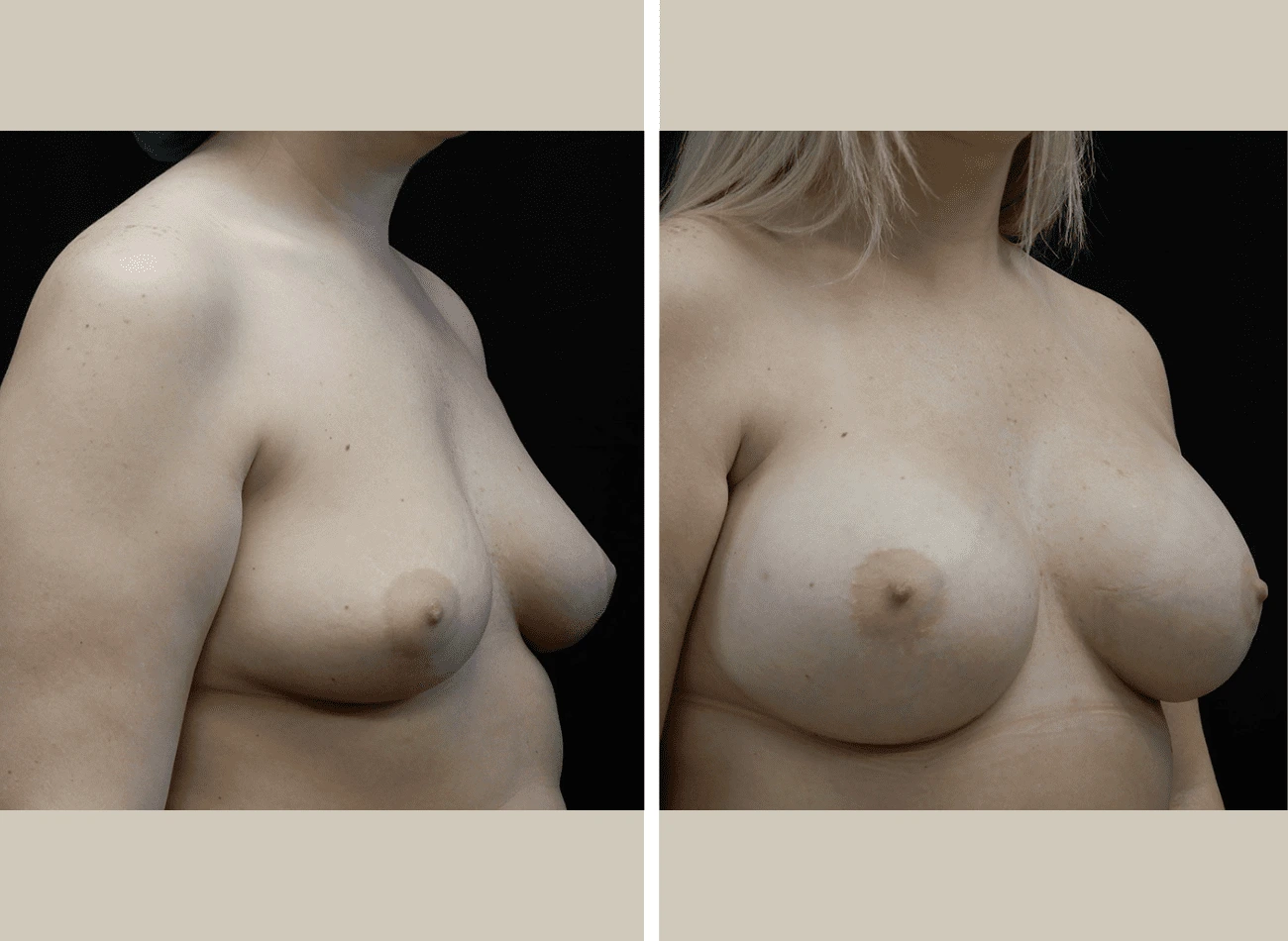 Breast augmentation before and after, oblique view