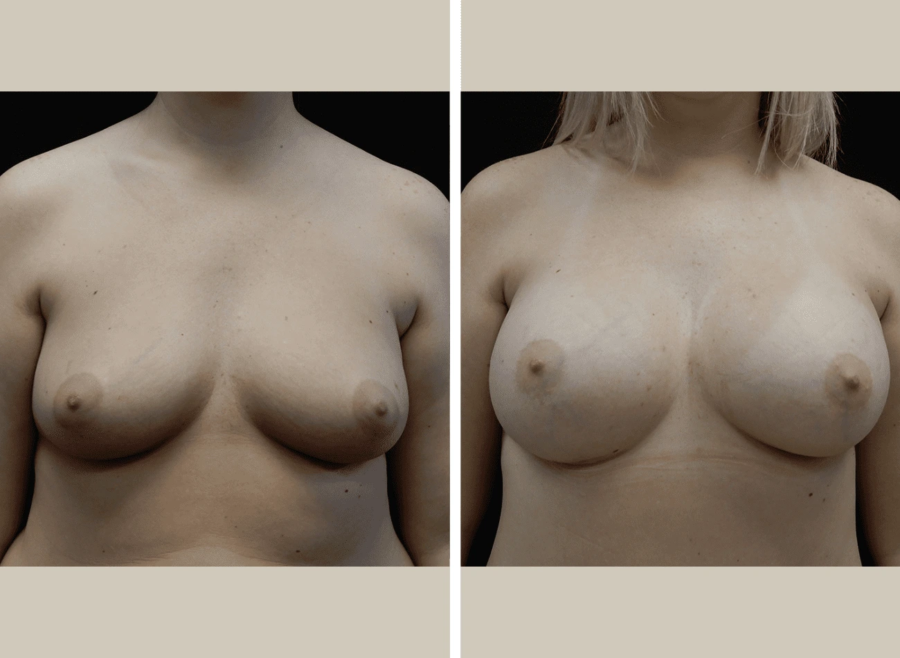 Breast augmentation before and after, front view
