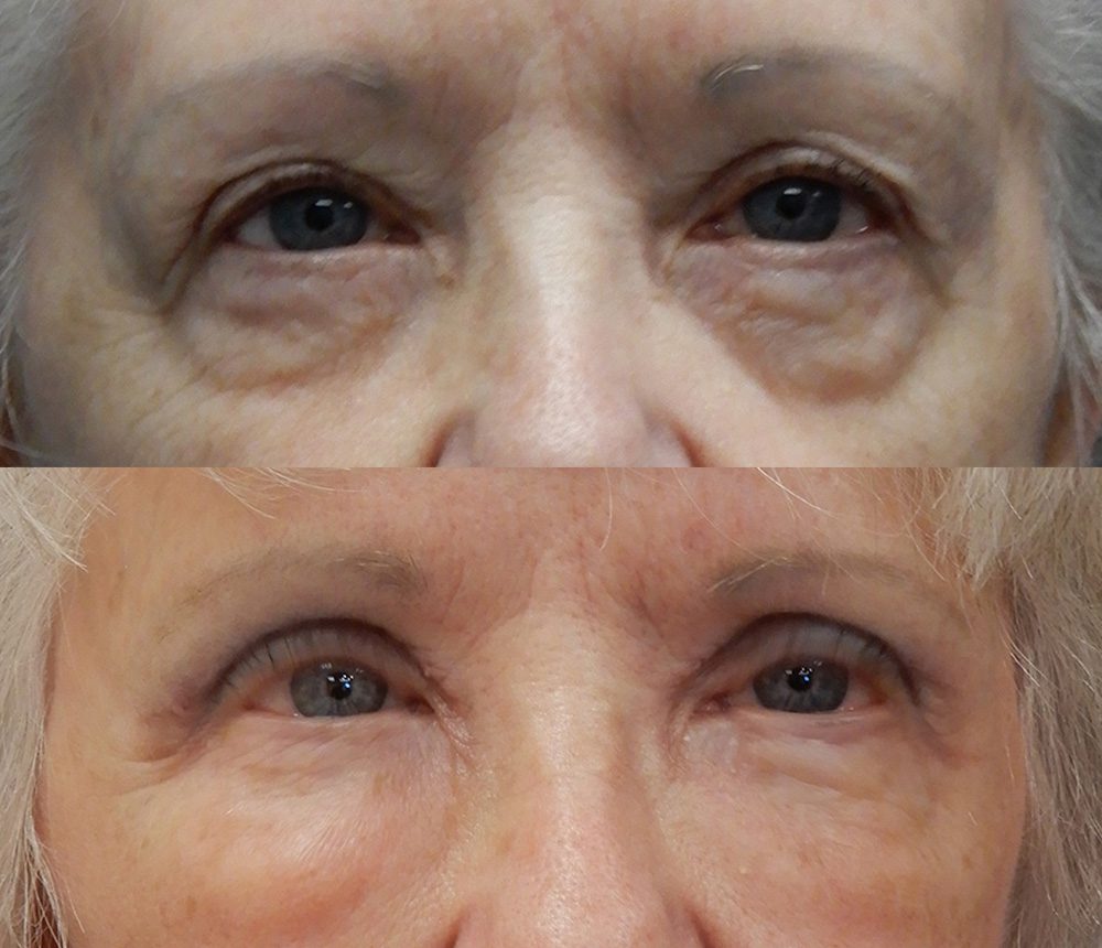 eyes-frontal