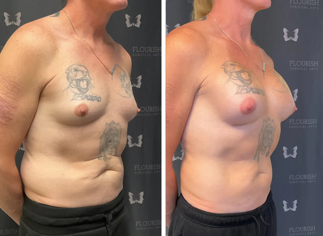 Breast Aug 1.1