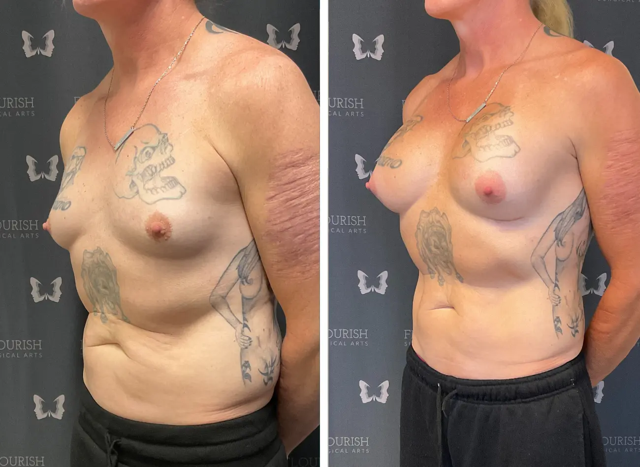 Breast Aug 1.2