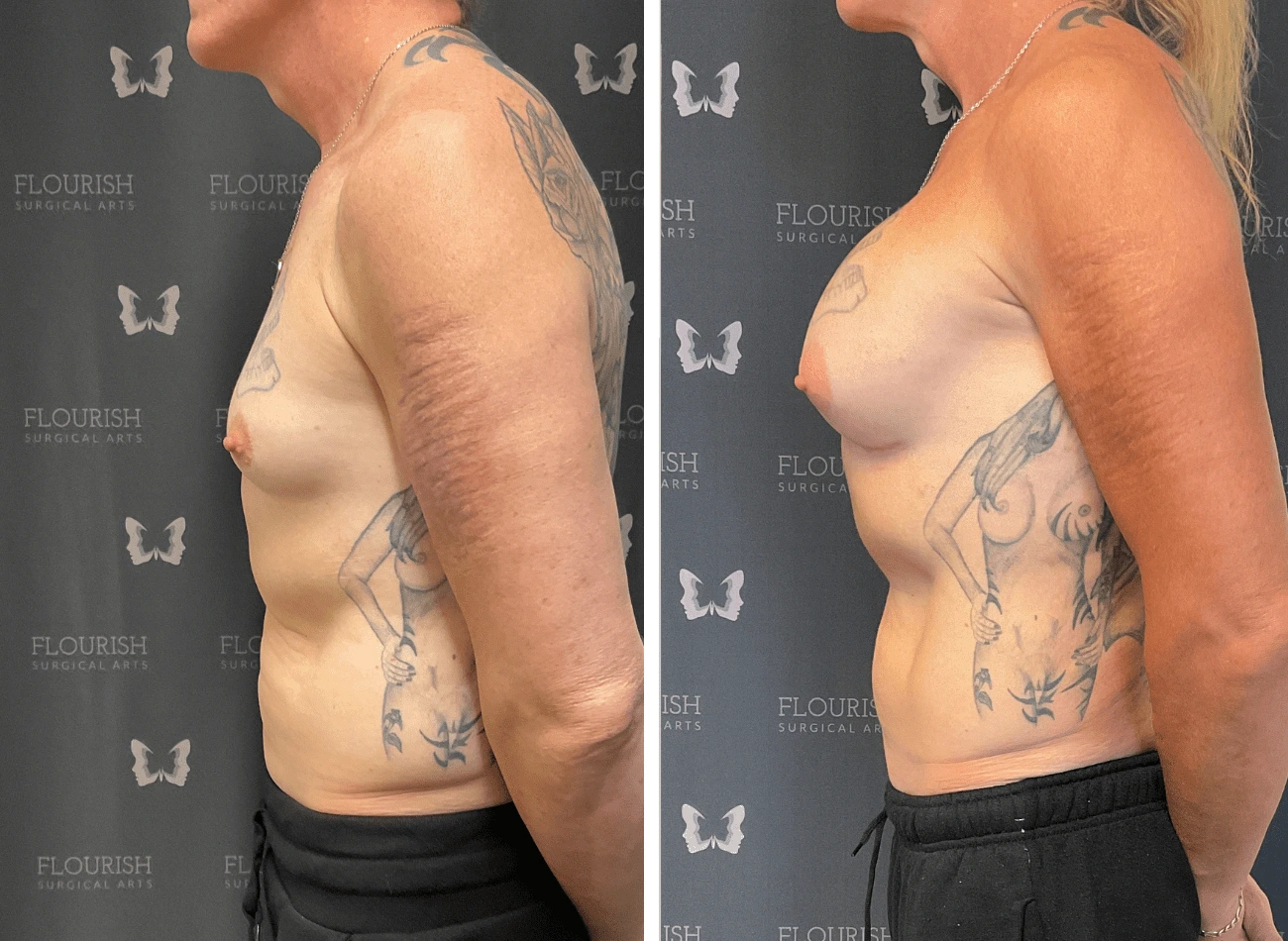 Breast Aug 1.3