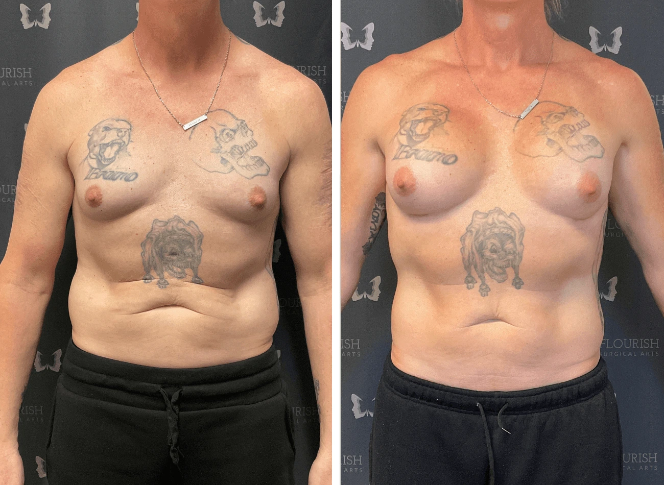 Breast Aug 1
