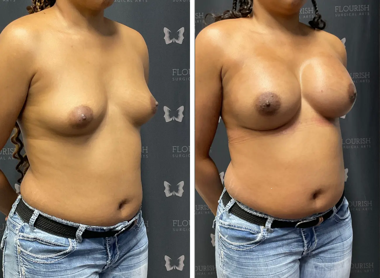 Breast Aug 3.1