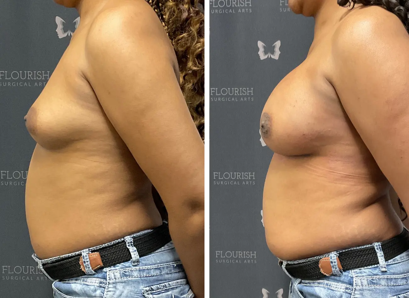Breast Aug 3.3