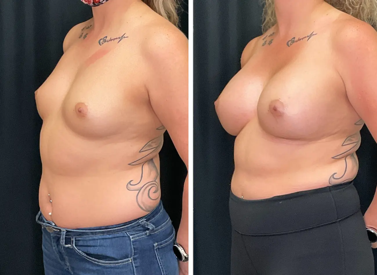 Breast Aug 4.4
