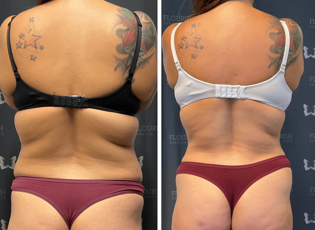 Lipo 1
