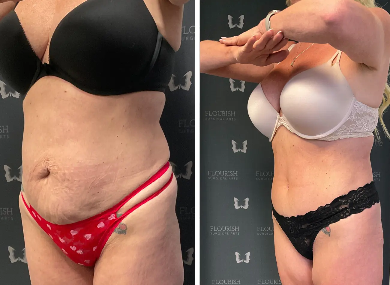 Lipo 2