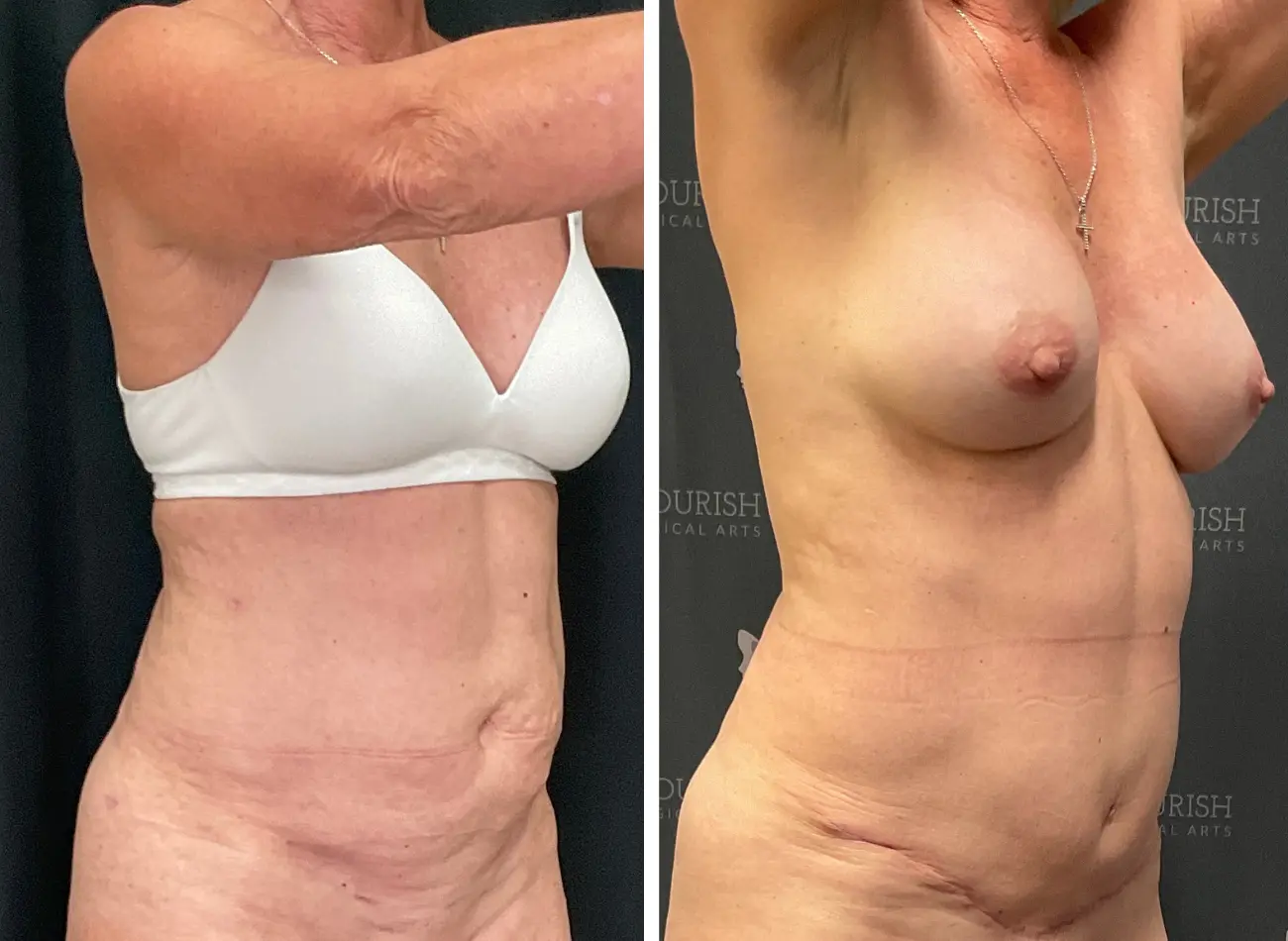 Lipo 3.1