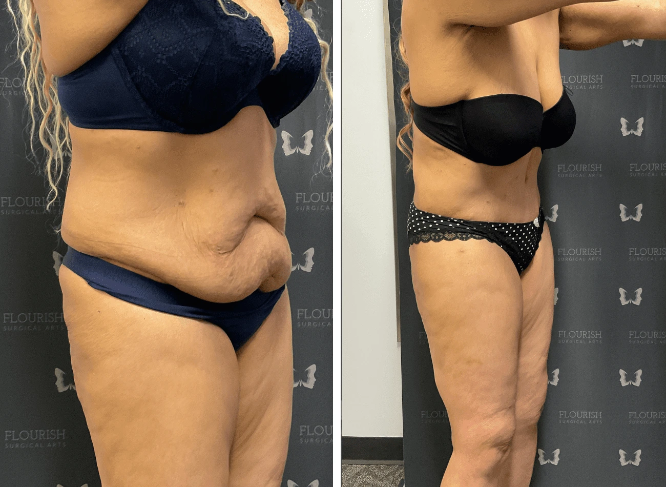 TT & Lipo 2.1