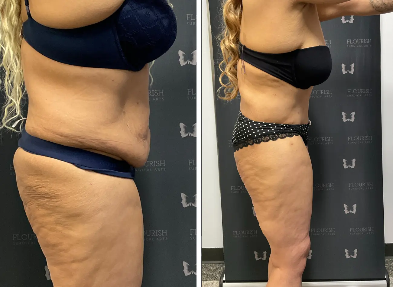 TT & Lipo 2.2