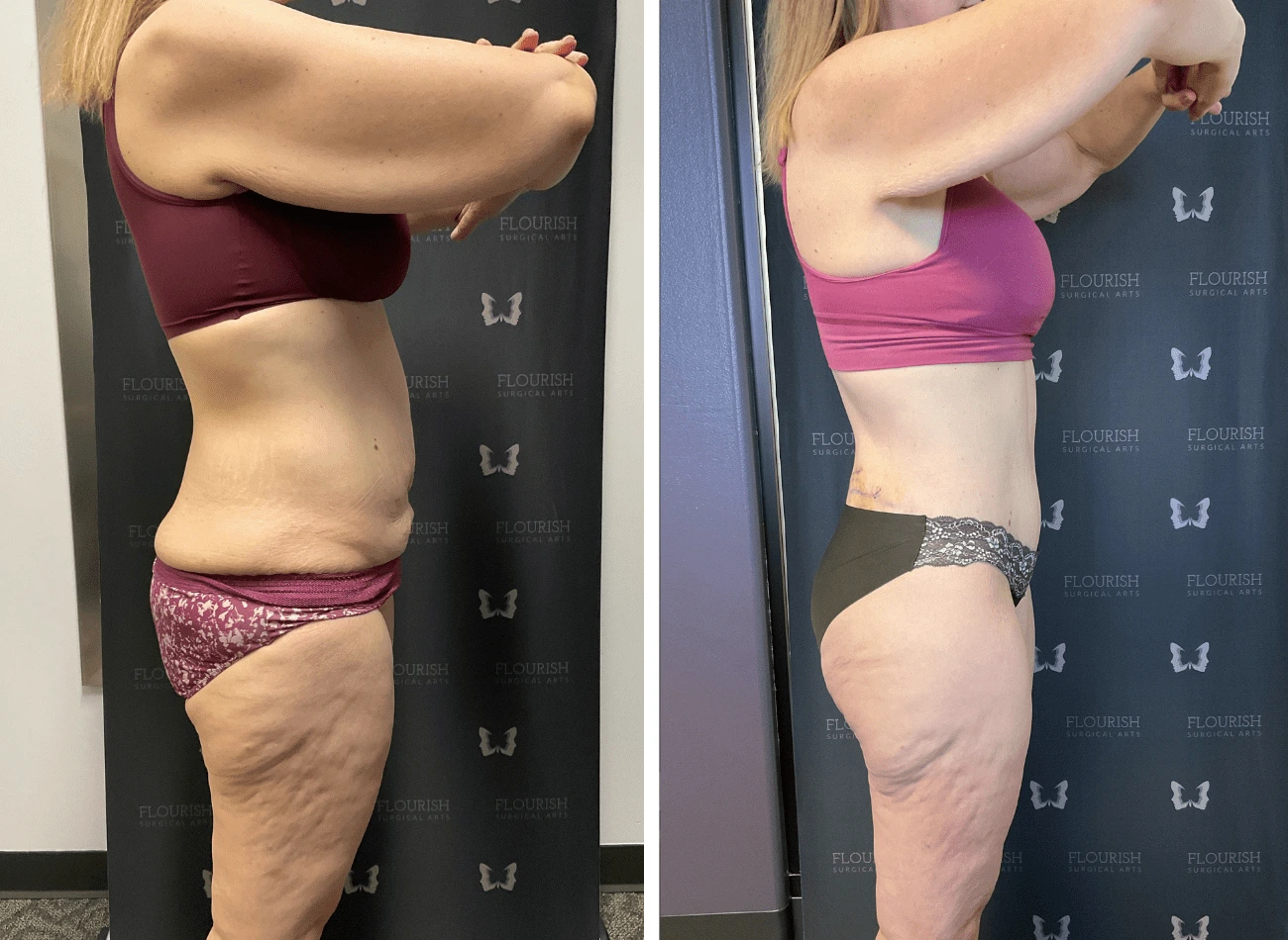 TT & Lipo 3.2