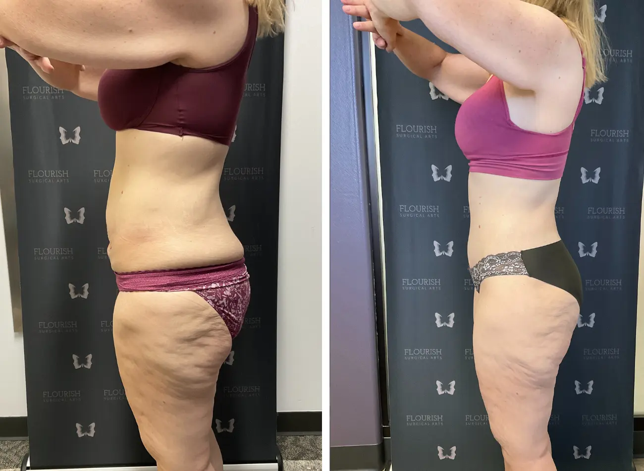 TT & Lipo 3.4