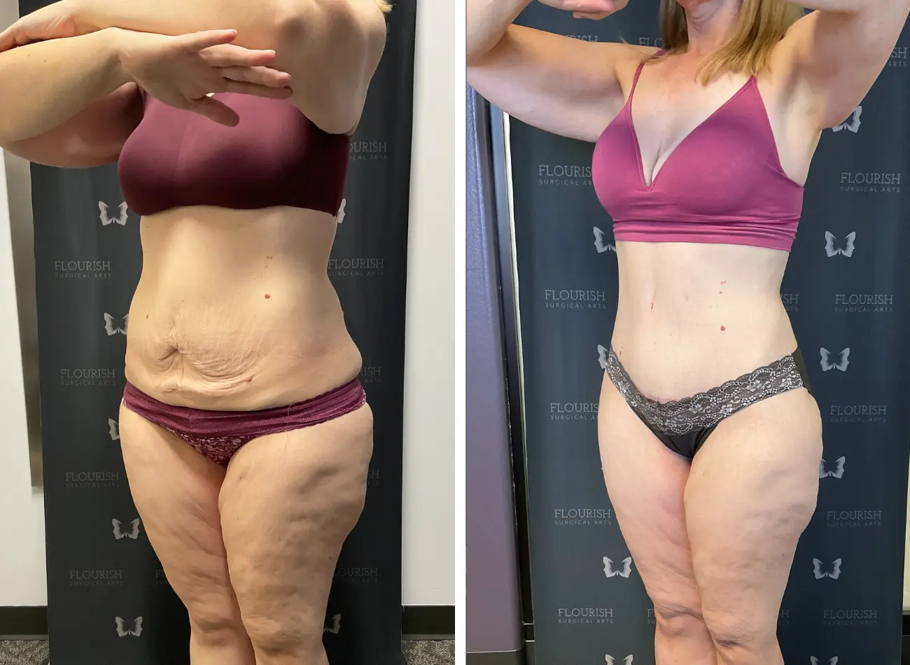 TT & Lipo 3.5