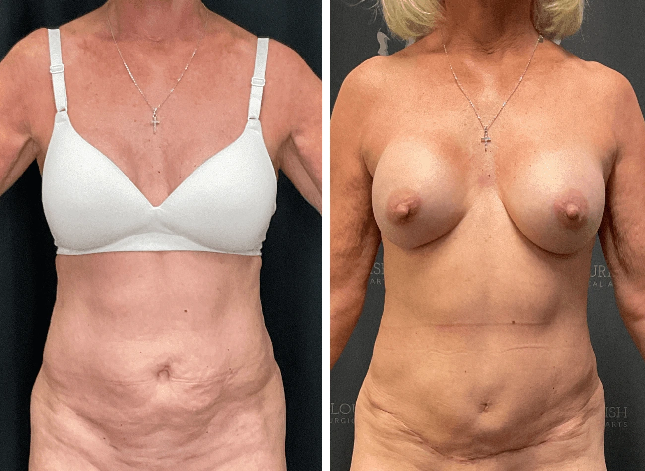 Before and After Gallery: Liposuction B Banner